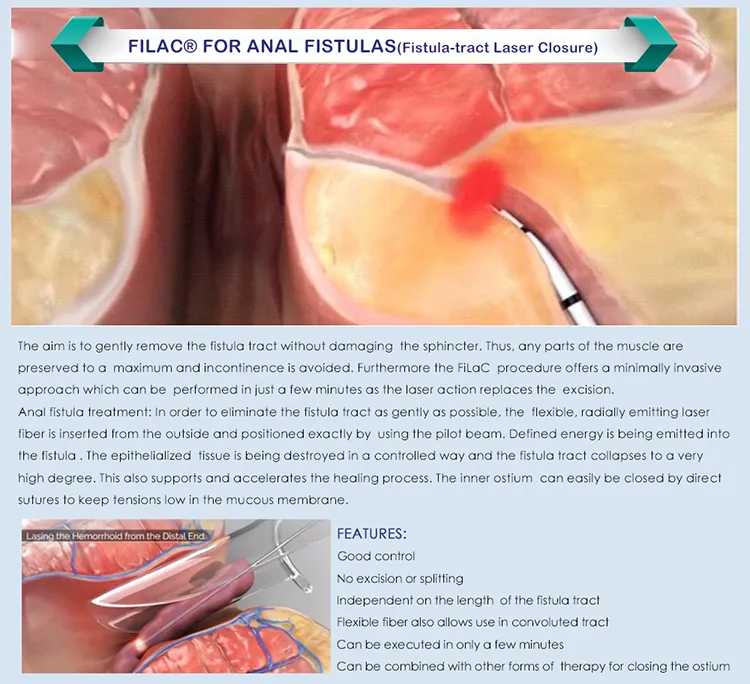 30W 17W Less Bleeding Dual 980nm 1470nm Surgical Laser for Haemorrhoids Anal Piles Fistula Fissure and Pilonidal Sinus