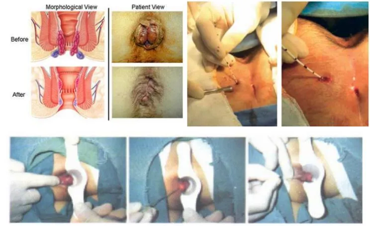 Top Sale German Tech Hospital Clinical Hemorrhoids Proctology Instruments Surgical 1470nm Laser